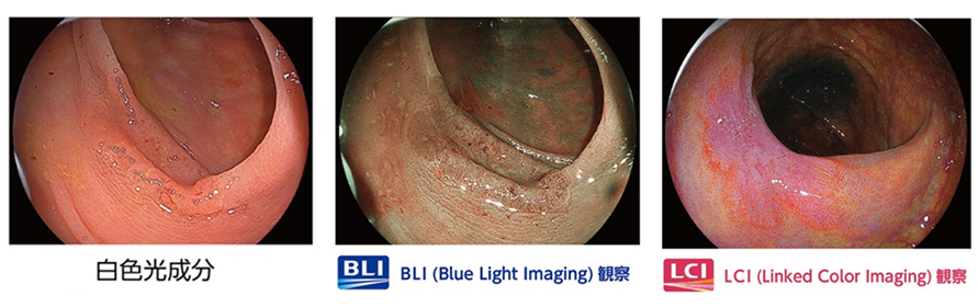 青色LEDの内視鏡で明るさを調整しながら視覚的な診断を